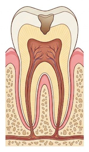 L'acide a percé l'émail et creuse la dentine